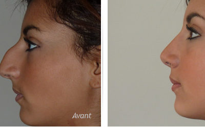 La rhinoplastie