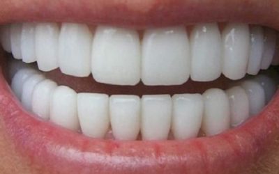 Comment faire pour avoir les dents blanches ?